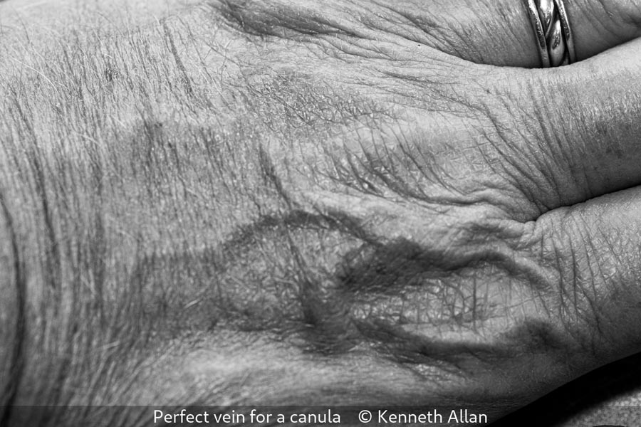 Kenneth Allan_Perfect vein for a canula
